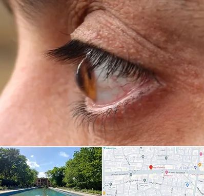 متخصص قوز قرنیه در هشت بهشت اصفهان