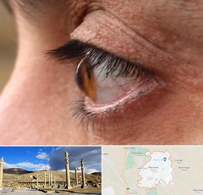 متخصص قوز قرنیه در مرودشت