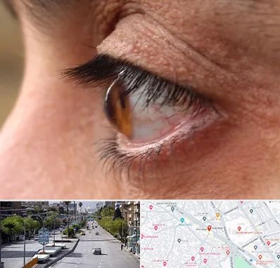 متخصص قوز قرنیه در خیابان زند شیراز