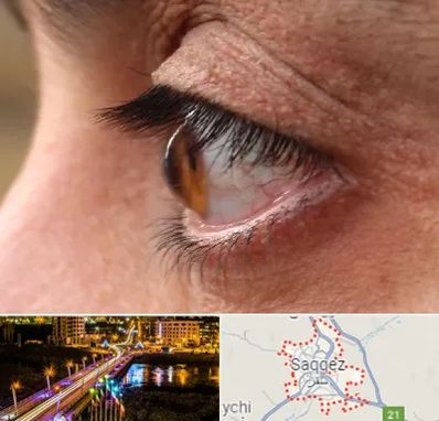 متخصص قوز قرنیه در سقز