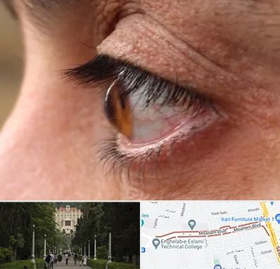 متخصص قوز قرنیه در بلوار معلم رشت 