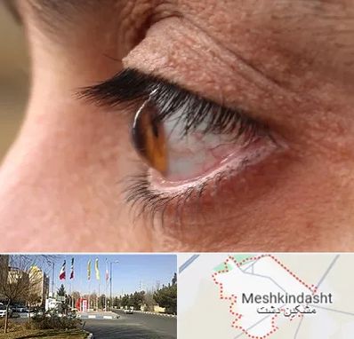متخصص قوز قرنیه در مشکین دشت