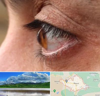 متخصص قوز قرنیه در مرند