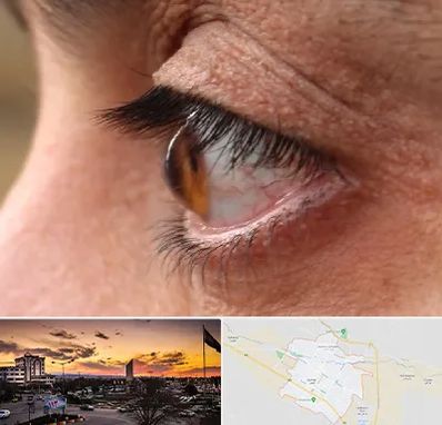 متخصص قوز قرنیه در قوچان