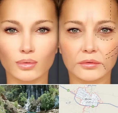 متخصص زیبایی چشم در شیروان
