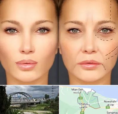 متخصص زیبایی چشم در چالوس