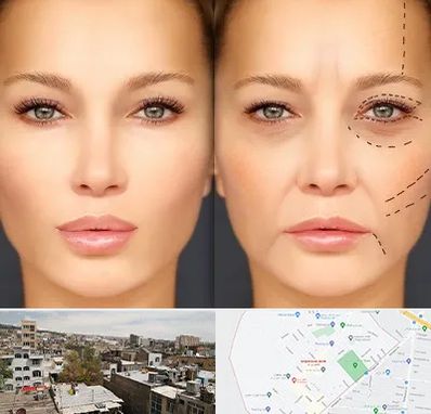 متخصص زیبایی چشم در شمیران نو