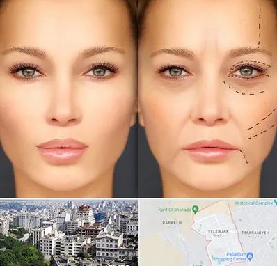 متخصص زیبایی چشم در ولنجک 