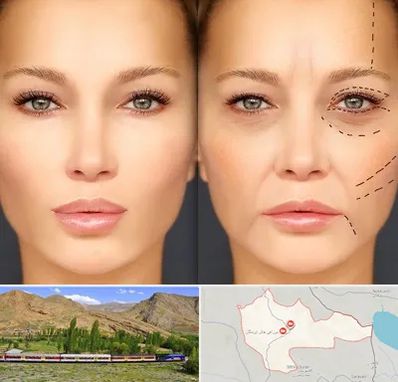 متخصص زیبایی چشم در خاش