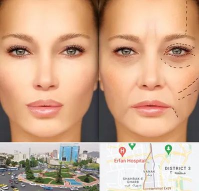 متخصص زیبایی چشم در ونک 