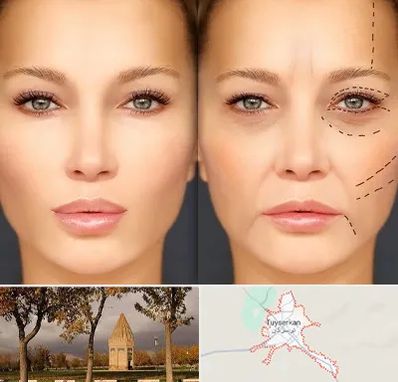 متخصص زیبایی چشم در تویسرکان