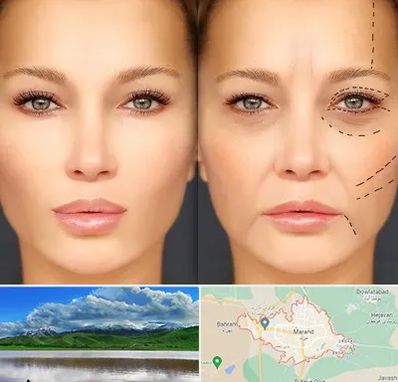 متخصص زیبایی چشم در مرند