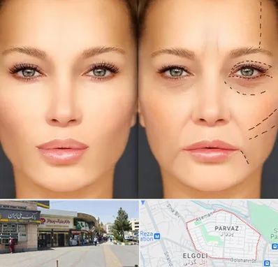 متخصص زیبایی چشم در پرواز تبریز