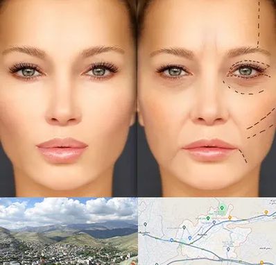 متخصص زیبایی چشم در رودهن