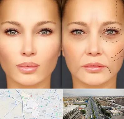 متخصص زیبایی چشم در حصارک کرج