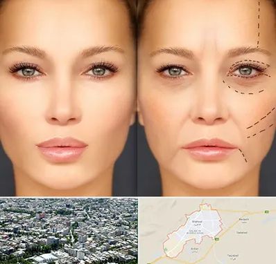 متخصص زیبایی چشم در شاهرود