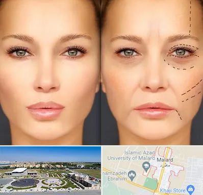 متخصص زیبایی چشم در ملارد