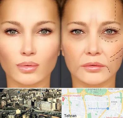 متخصص زیبایی چشم در مرزداران 
