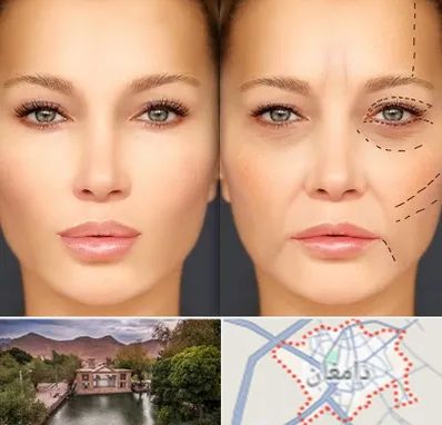 متخصص زیبایی چشم در دامغان