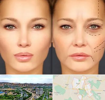 متخصص زیبایی چشم در شهریار