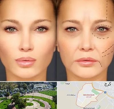 متخصص زیبایی چشم در مهرشهر کرج 