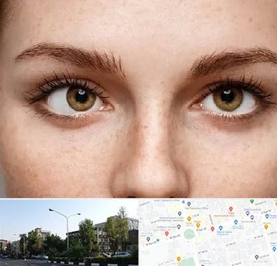 متخصص انحراف چشم در میدان کاج 