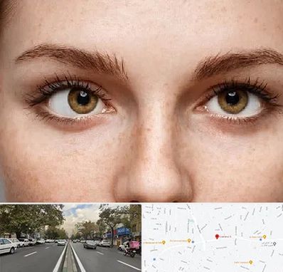 متخصص انحراف چشم در دولت 