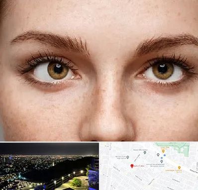 متخصص انحراف چشم در هفت تیر مشهد 