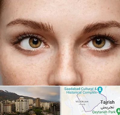 متخصص انحراف چشم در زعفرانیه 