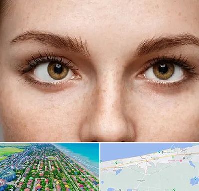 متخصص انحراف چشم در فریدونکنار