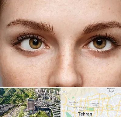 متخصص انحراف چشم در شمال تهران 