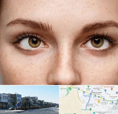 متخصص انحراف چشم در شریعتی مشهد
