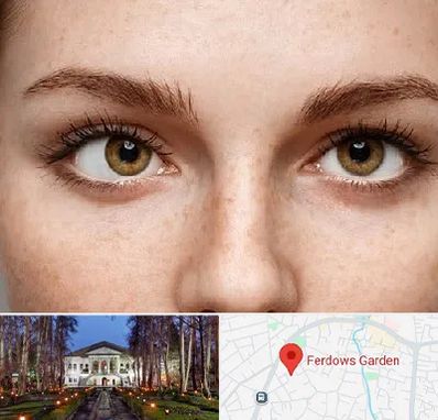 متخصص انحراف چشم در باغ فردوس