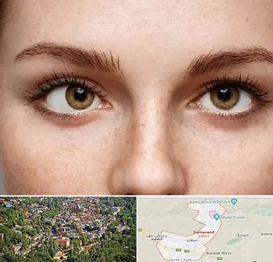 متخصص انحراف چشم در دماوند