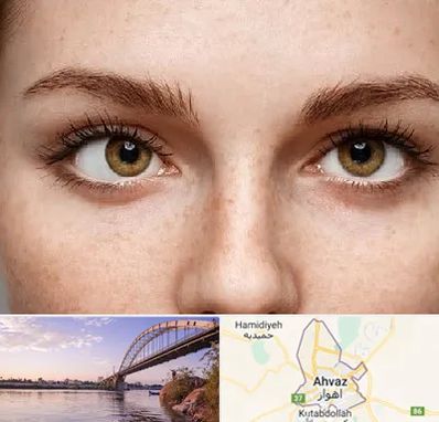 متخصص انحراف چشم در اهواز