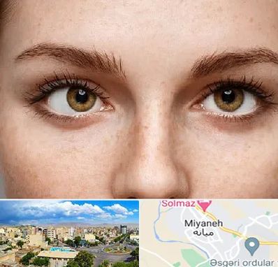 متخصص انحراف چشم در میانه