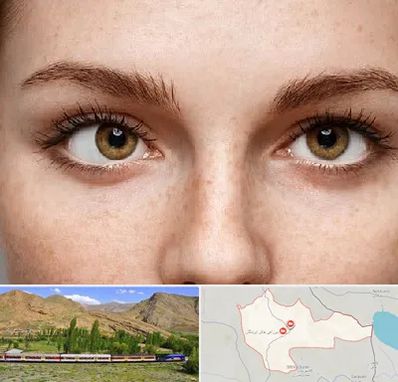 متخصص انحراف چشم در خاش