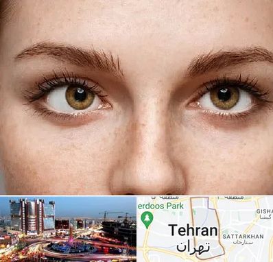 متخصص انحراف چشم در صادقیه 