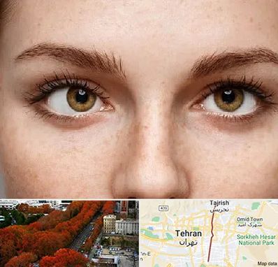 متخصص انحراف چشم در ولیعصر 