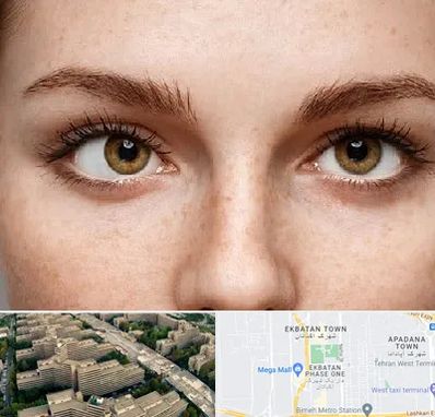 متخصص انحراف چشم در اکباتان 