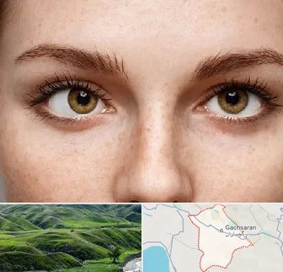 متخصص انحراف چشم در گچساران