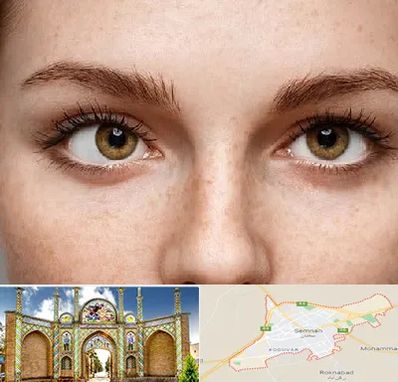 متخصص انحراف چشم در سمنان