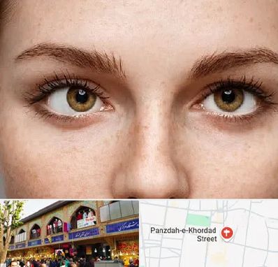 متخصص انحراف چشم در 15 خرداد