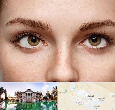 متخصص انحراف چشم در شیراز