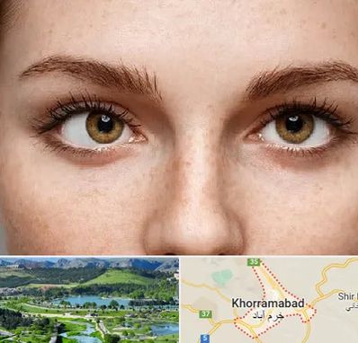 متخصص انحراف چشم در خرم آباد