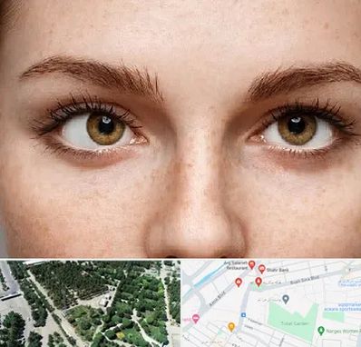 متخصص انحراف چشم در سالاریه قم