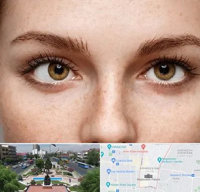 متخصص انحراف چشم در بهارستان 