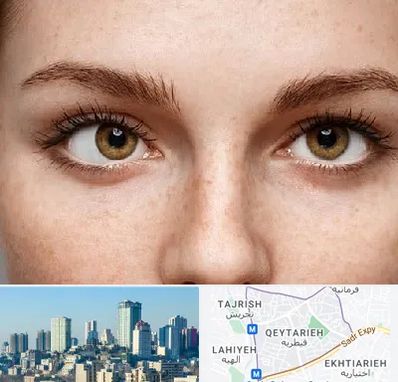 متخصص انحراف چشم در قیطریه 