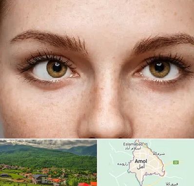 متخصص انحراف چشم در آمل