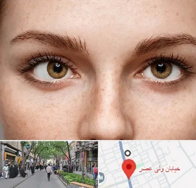 متخصص انحراف چشم در ولیعصر شهریار